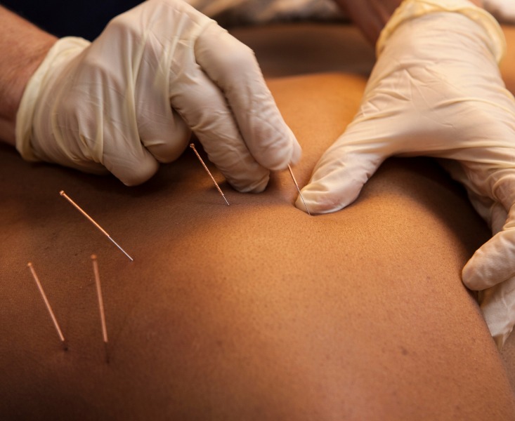 Dry Needling in Physiotherapy Clinic